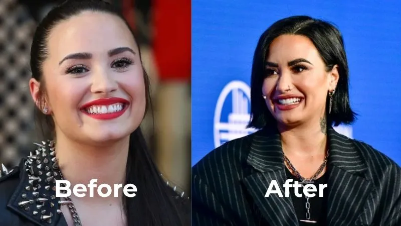 Demi Lovato veneers before after Demi Lovato veneers before after