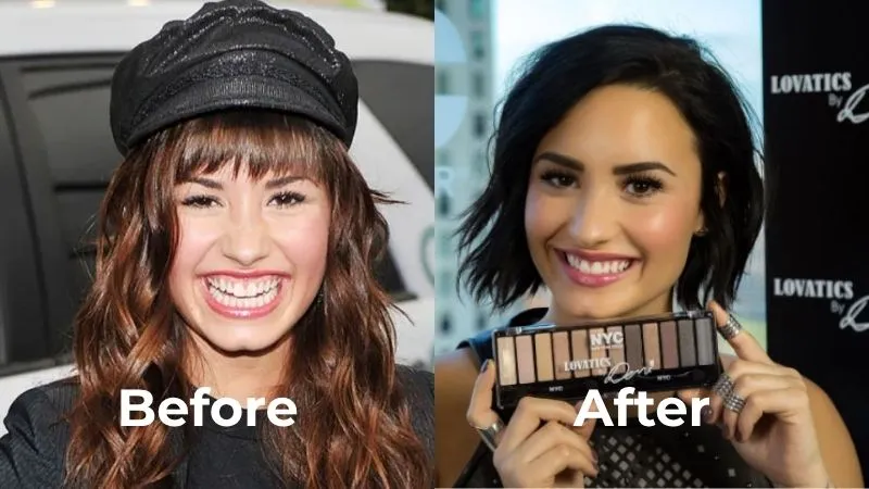 Demi Lovato teeth before after Demi Lovato teeth before after