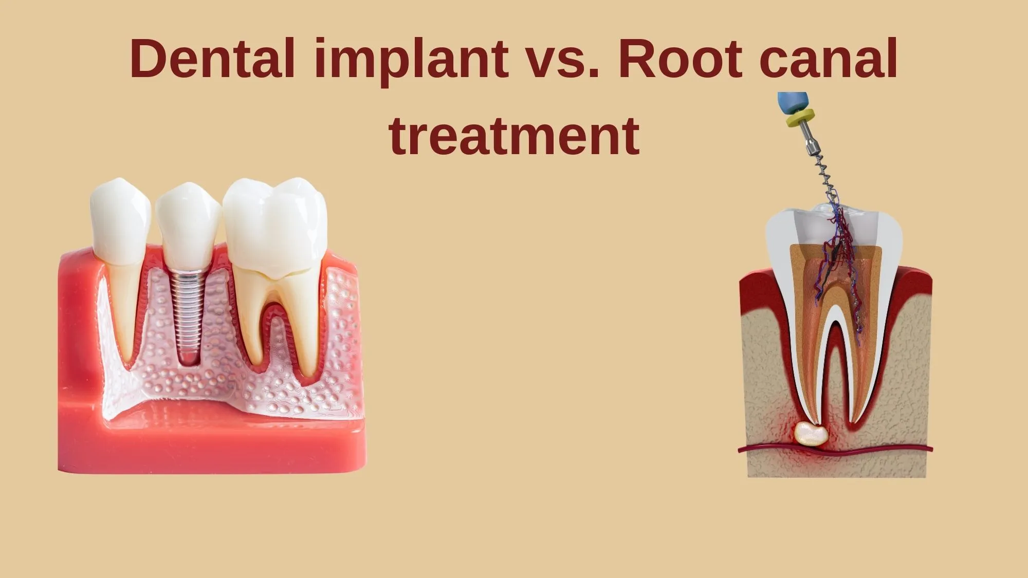 Dental implant vs. root canal treatment