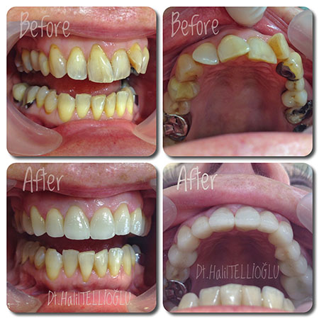 Fethiye Dental Treatments Before After Photos