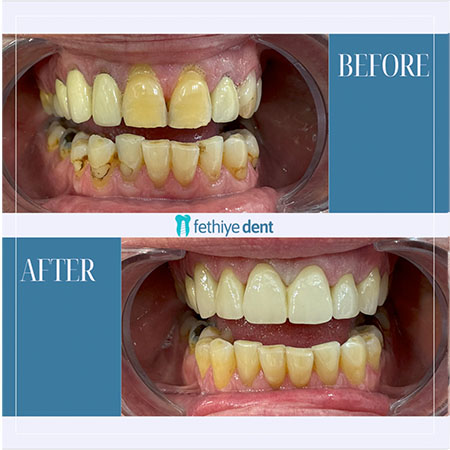 Fethiye Dental Treatments Before After Photos9