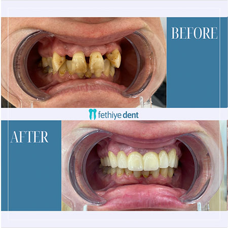 Fethiye Dental Treatments Before After Photos10