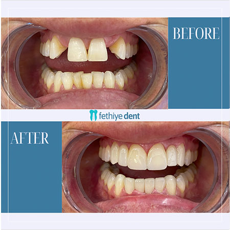 Fethiye Dental Treatments Before After Photos11