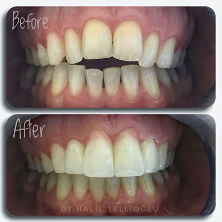 Fethiye Dental Treatments Before After Photos1