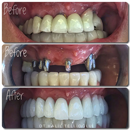 Fethiye Dental Treatments Before After Photos2