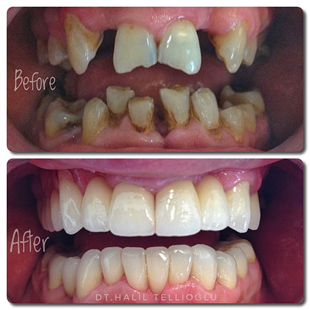 Fethiye Dental Treatments Before After Photos3