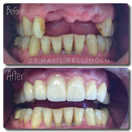 Fethiye Dental Treatments Before After Photos4