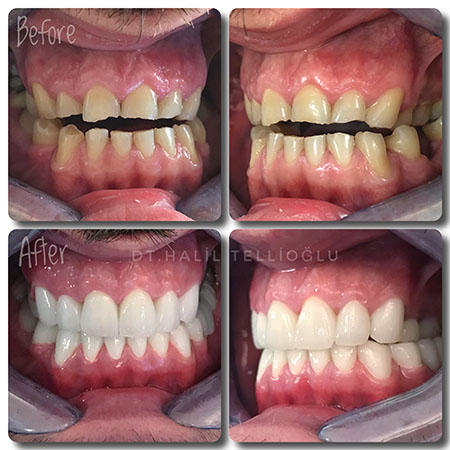 Fethiye Dental Treatments Before After Photos5