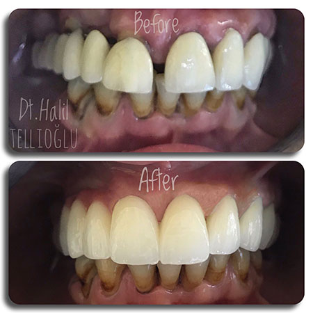 Fethiye Dental Treatments Before After Photos6