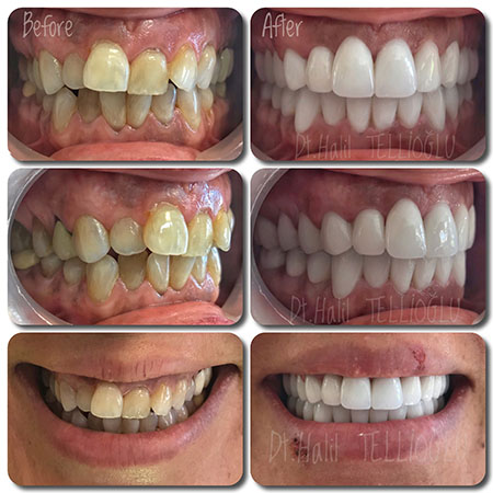 Fethiye Dental Treatments Before After Photos7