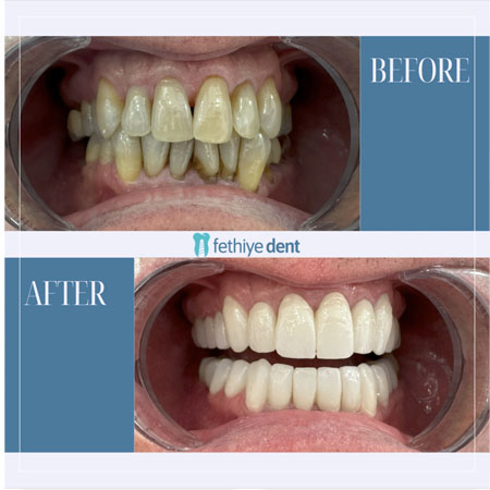 Fethiye Dental Treatments Before After Photos8