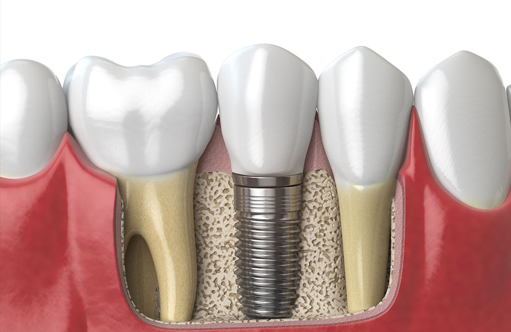 Dental Implant in Turkey