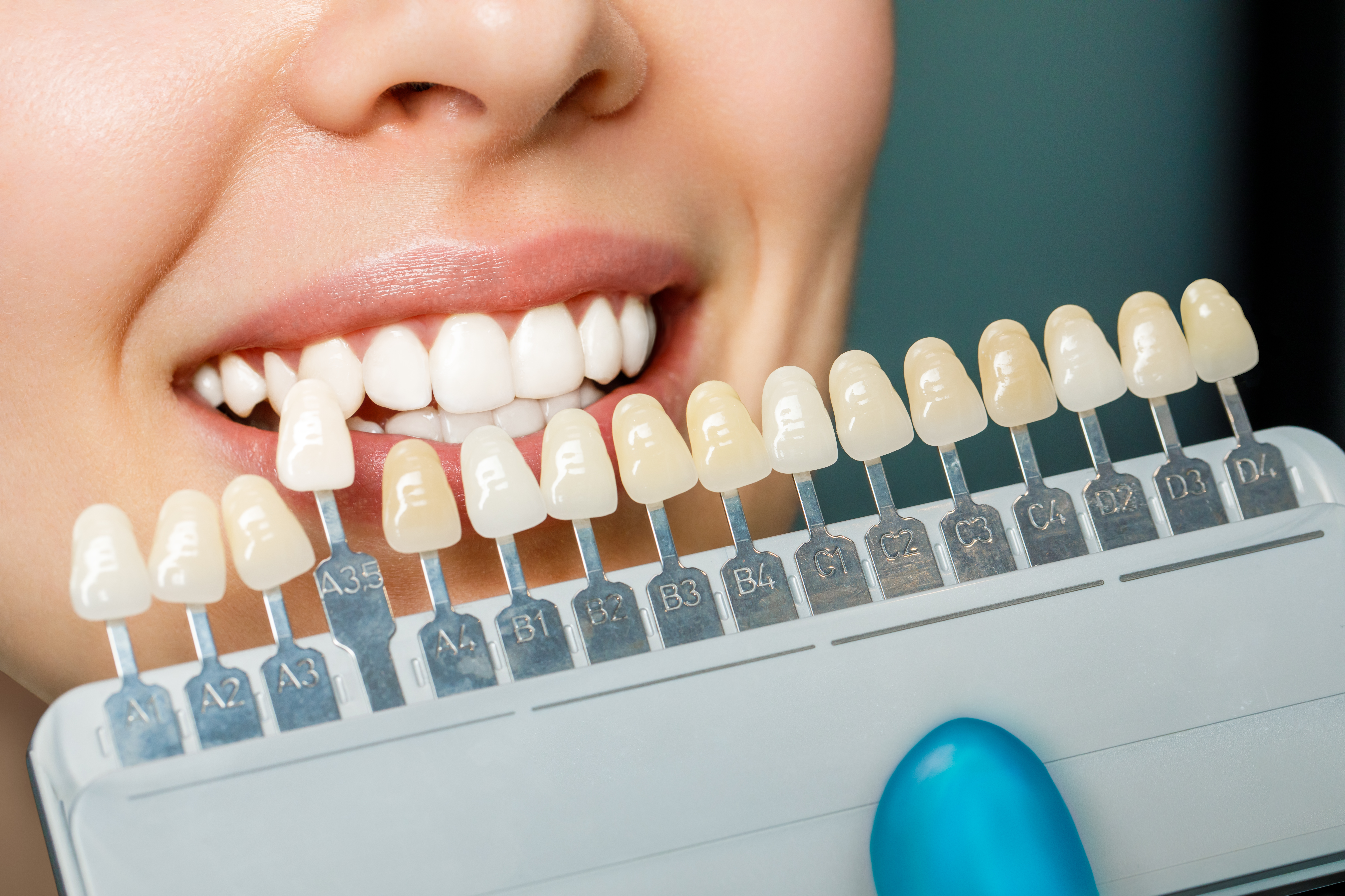 Emax Laminate Veneers Turkey Emax Laminate Veneers Turkey