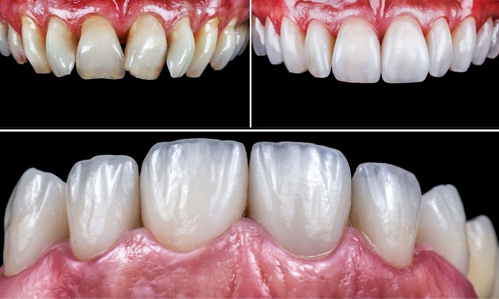Emax Veneers Turkey Emax Veneers Fethiye